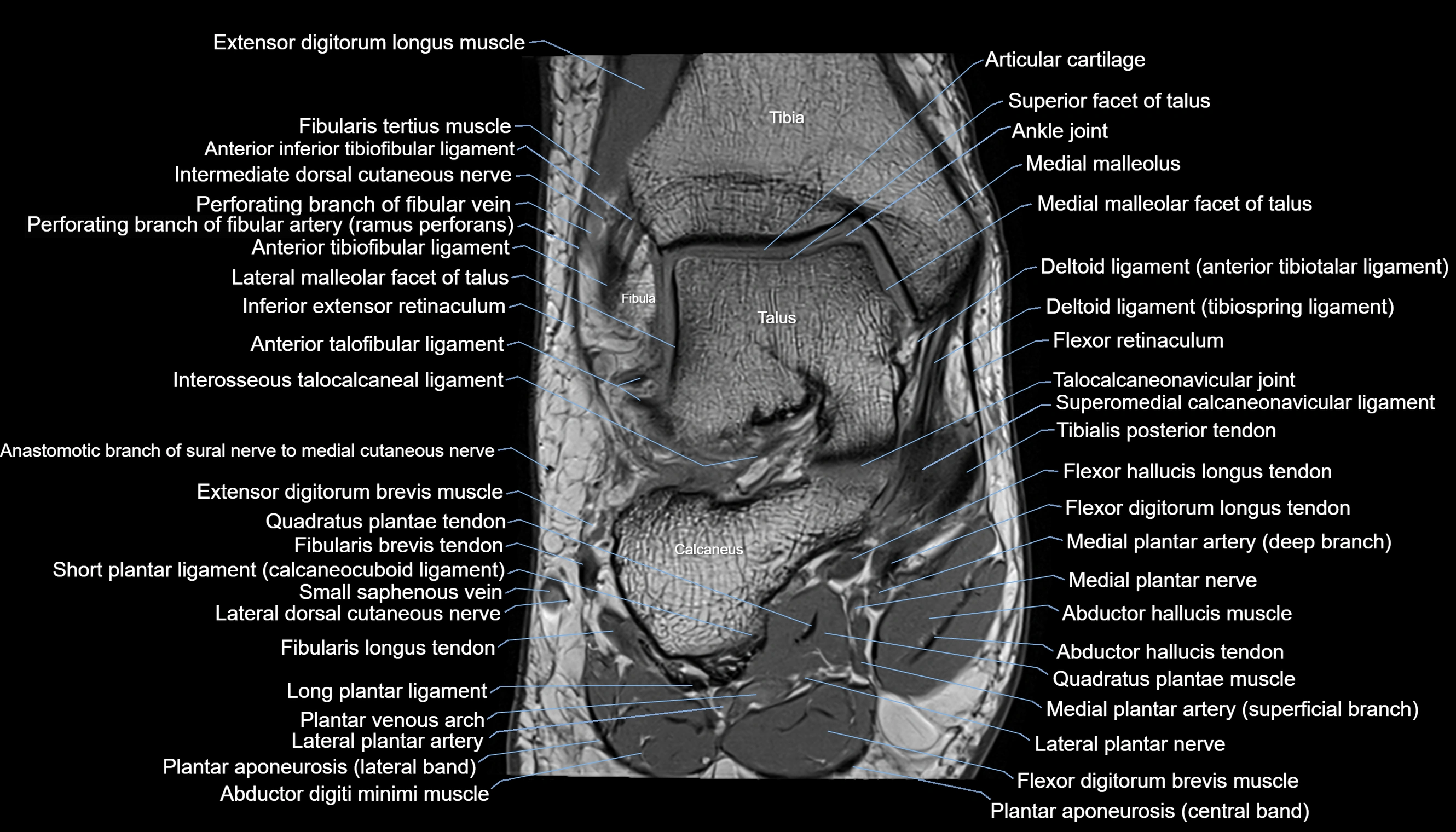 Ankle coronal anatomy 3T MRI images -img-11001-00009.webp